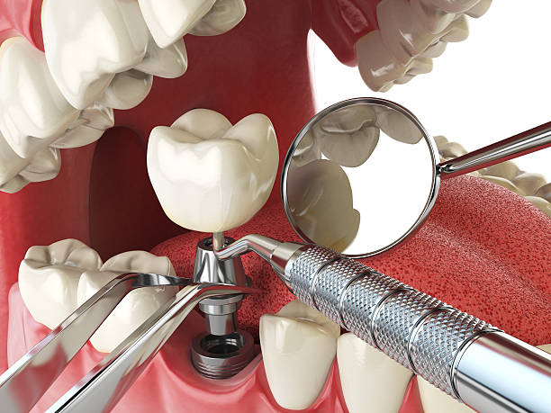 Best Emergency Dentist for Knocked-Out Tooth in Huntsville, TN